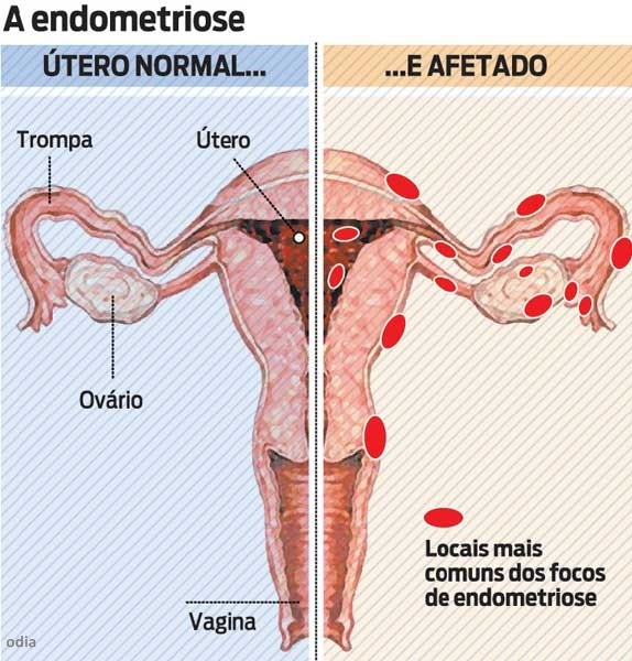 Endometriose: O mal do século?