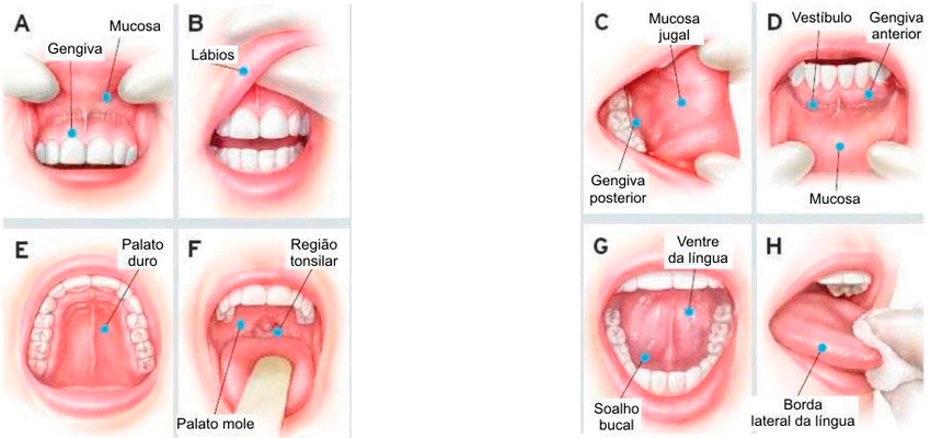 Cancer bucal campana. Cancer bucal campana Cancer bucal prevencion