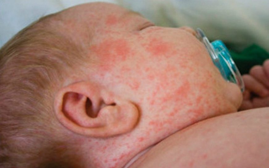 Sarampo e pólio de volta