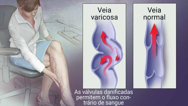 Varizes: por que surgem e como tratar