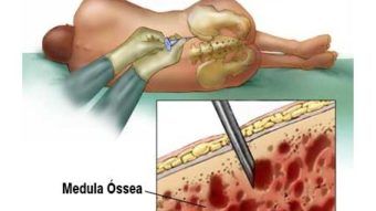 Transplante de medula óssea é a principal opção para cura de doenças graves do sangue