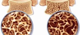 Mitos e Verdades sobre Osteoporose
