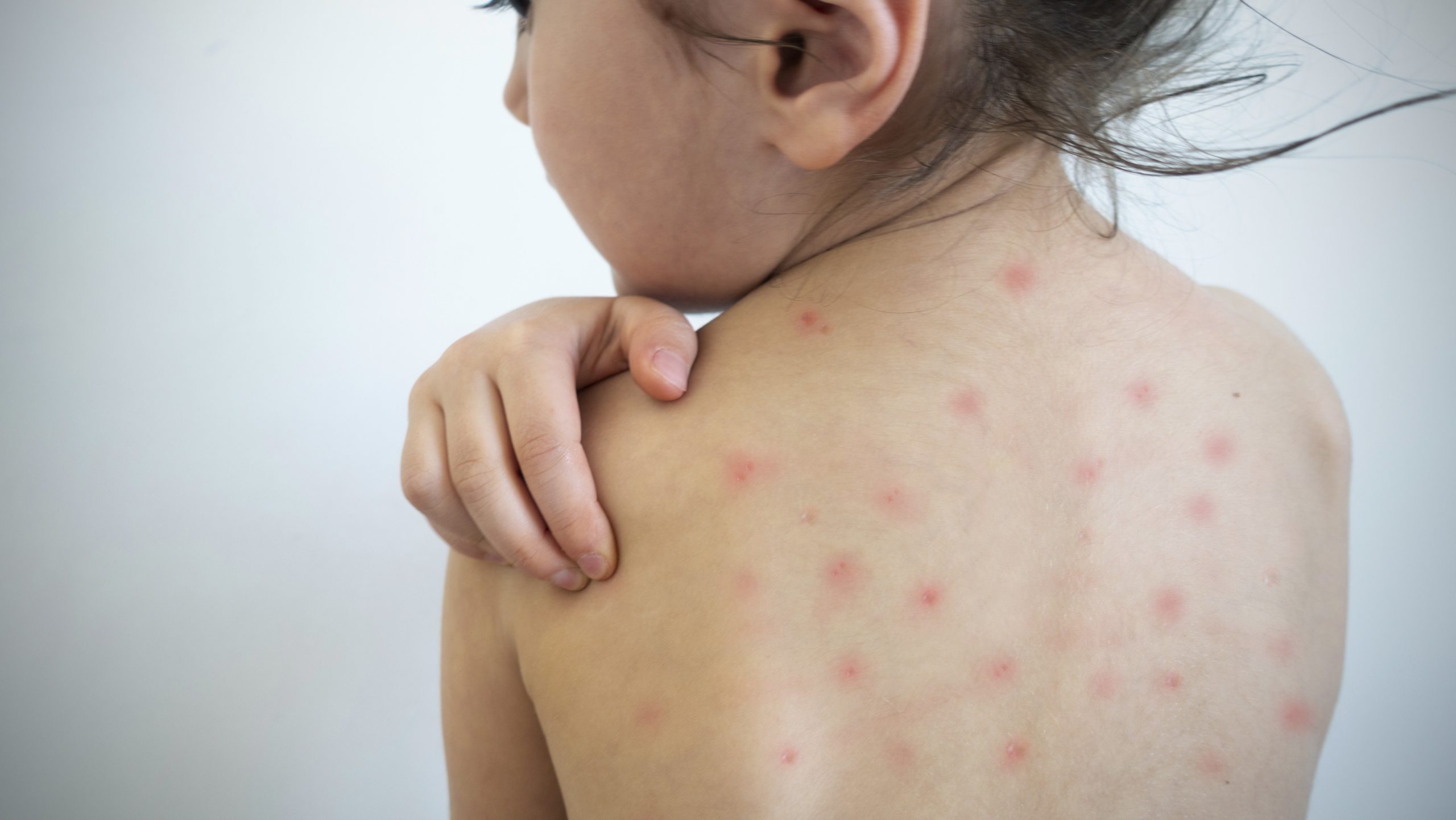 Campanha contra sarampo vai até março