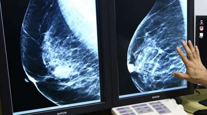 Pandemia diminui números de exames preventivos e mamografias em Taubaté