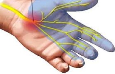 Síndrome do Túnel do Carpo: saiba como identificar e cuidar dos sintomas