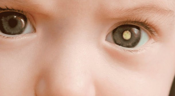 Retinoblastoma: entenda o câncer nos olhos da filha de Tiago Leifert e Daiana Garbin