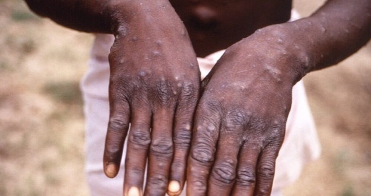 OMS diz que situação epidemiológica da varíola dos macacos no Brasil é “preocupante”